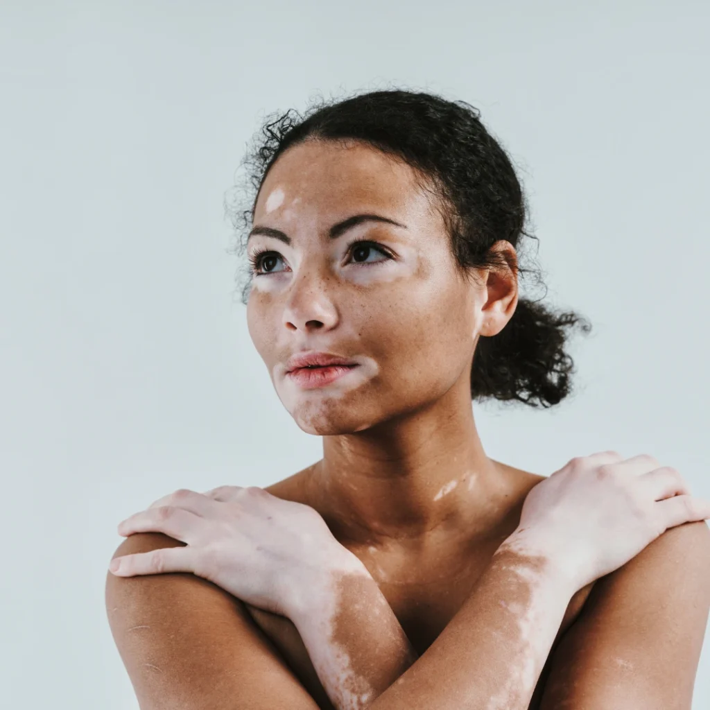 White Patches on Face: Causes, Treatments & Prevention Tips