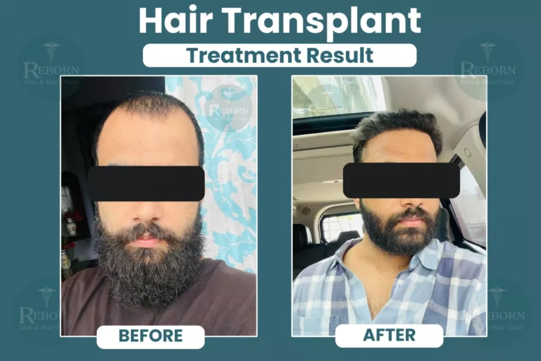 Before and after hair transplant result of a male patient showing restored frontal hairline, increased hair density, and natural hair growth at Reborn Skin & Hair Clinic, Bapu Nagar, Jaipur.
