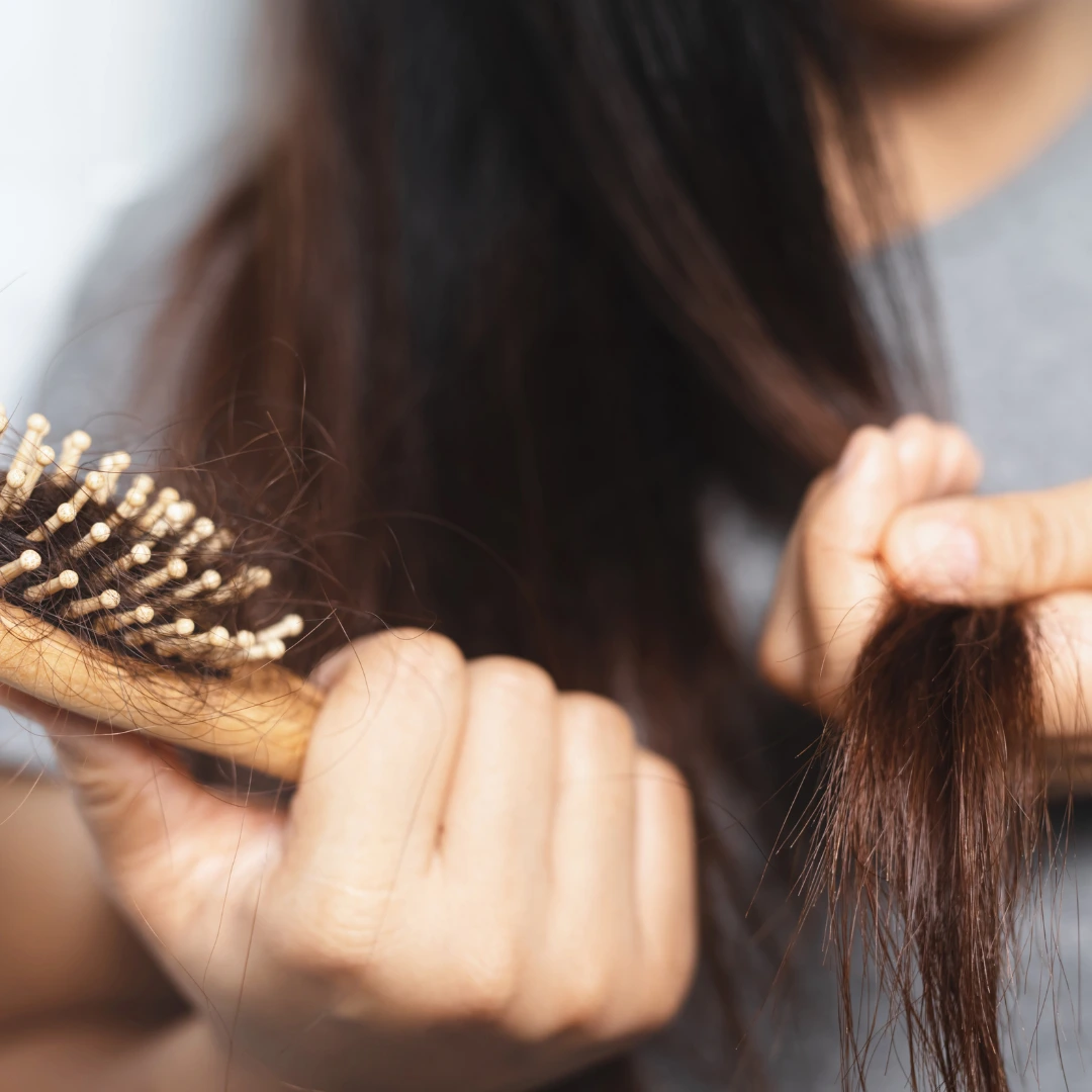 PCOS Hair Loss - Unveiling the Best Treatments to Restore Your Locks