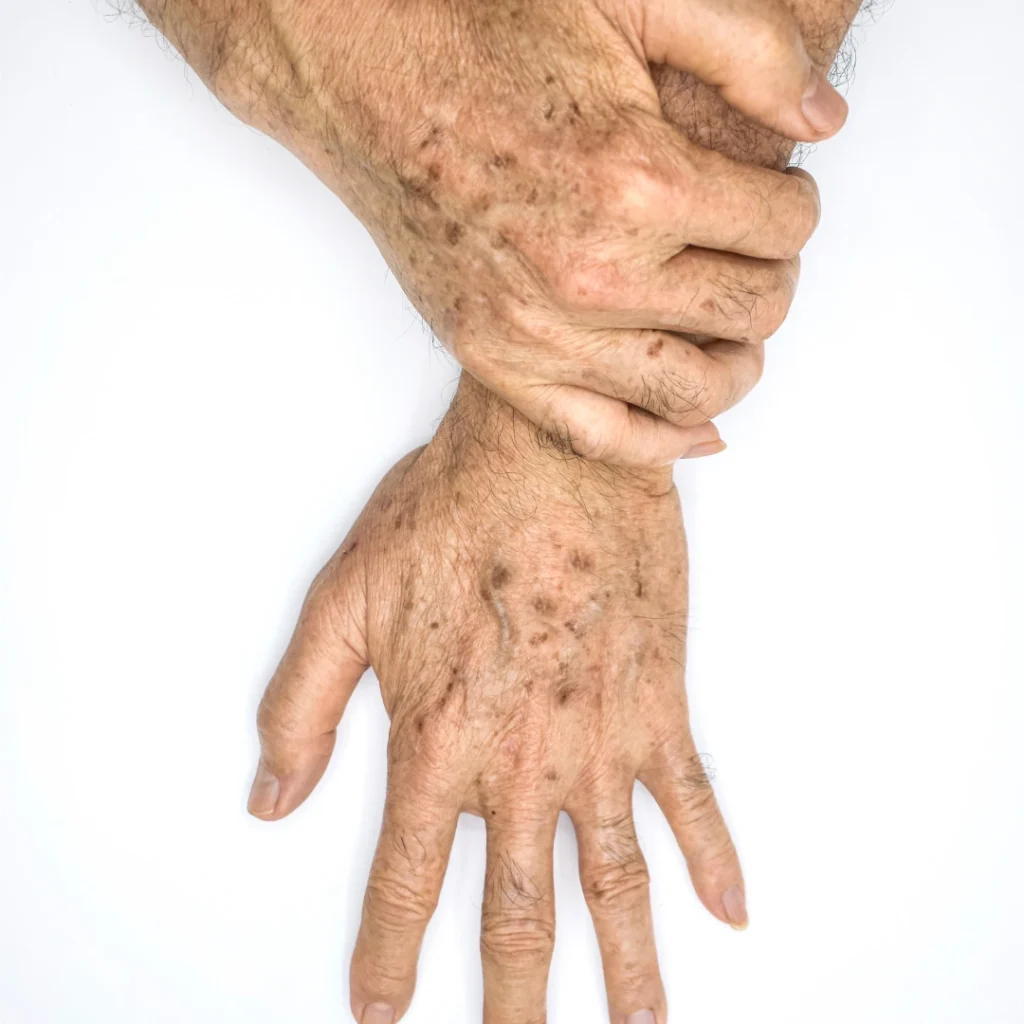 difference between age spots and sun spots - how to identify and treat themdifference between age spots and sun spots - how to identify and treat them