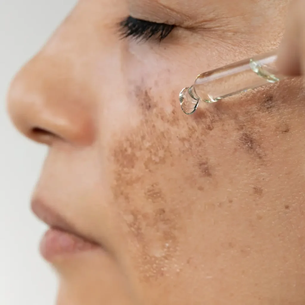 prp treatment for melasma success way to enjoy a brighter skin