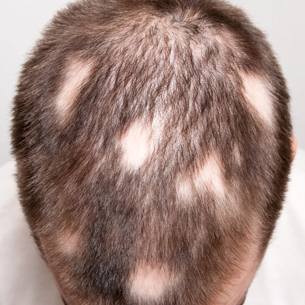 Alopecia Areata Causes Unveiled Gender-Specific Factors Explored