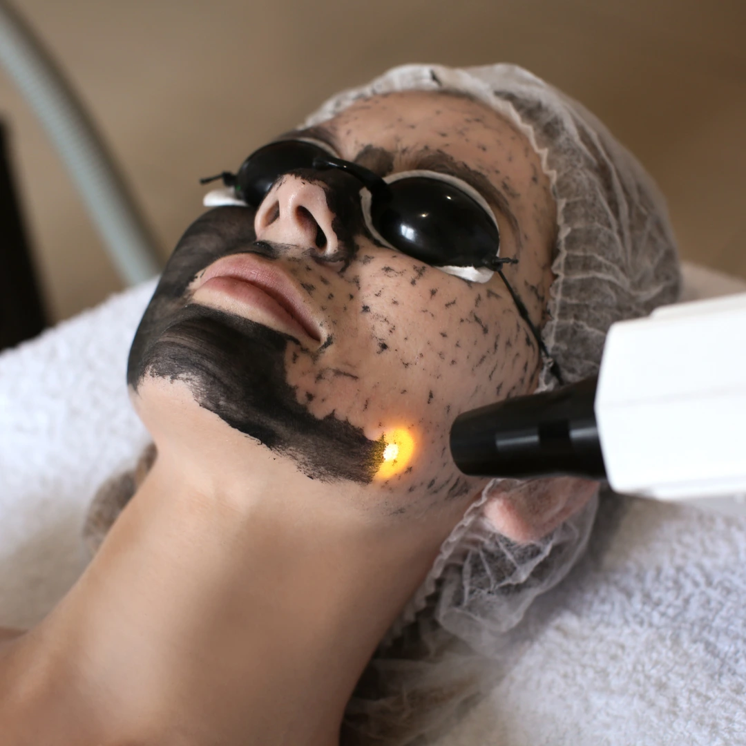 Carbon Peel Treatment in Pune Complete Guide and Benefits of Carbon Peeling