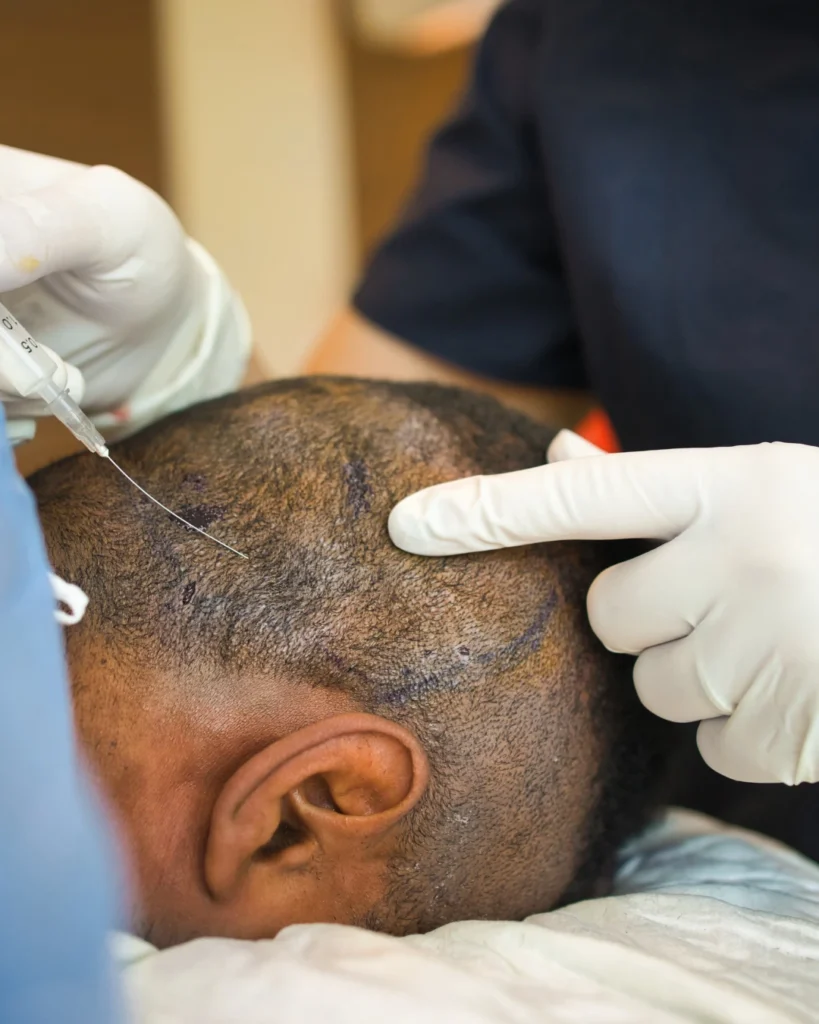 Hair Transplant Revisions in Pune Procedure and Benefits for Punekars