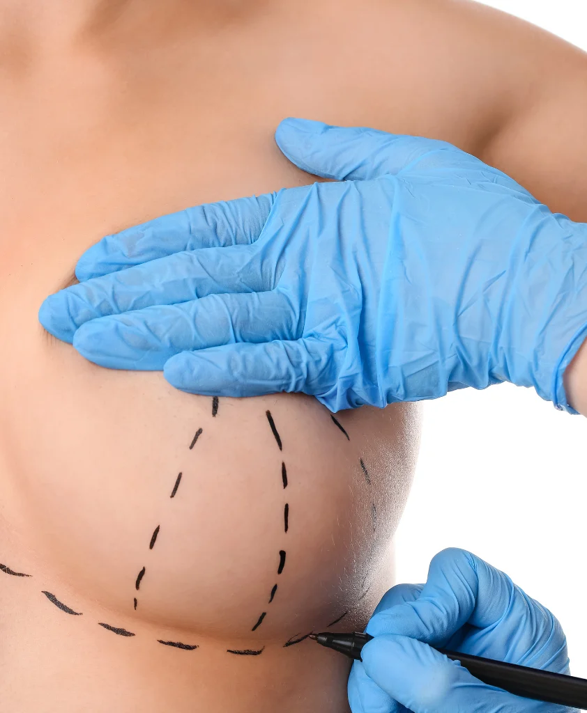 Breast-Lift-Surgery