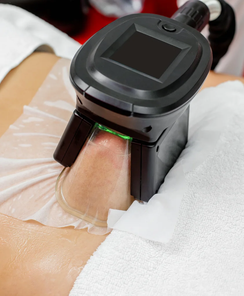 Cryopolysis