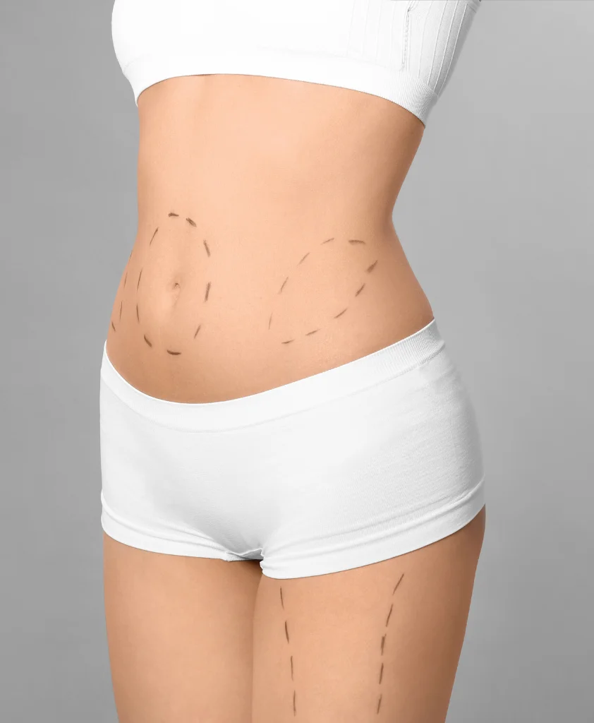 Liposuction-Surgery