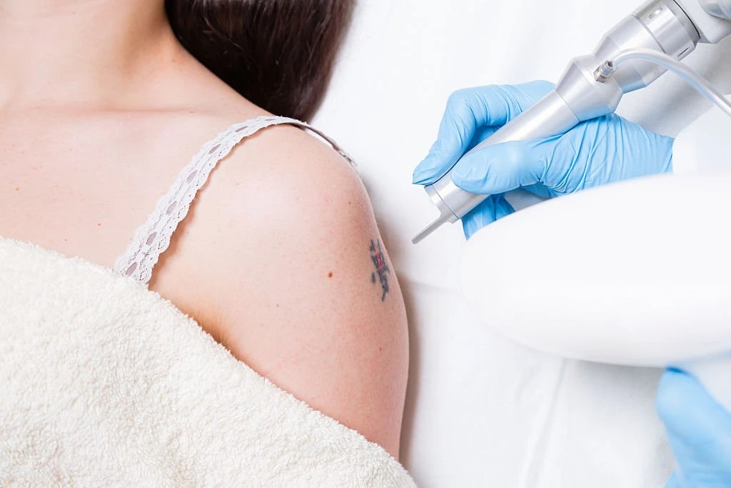 tattoo removal image
