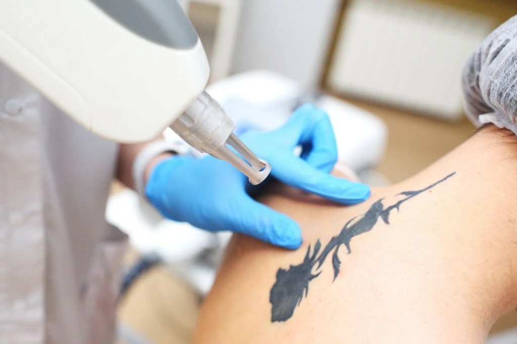 Who Qualifies for Tattoo Removal?