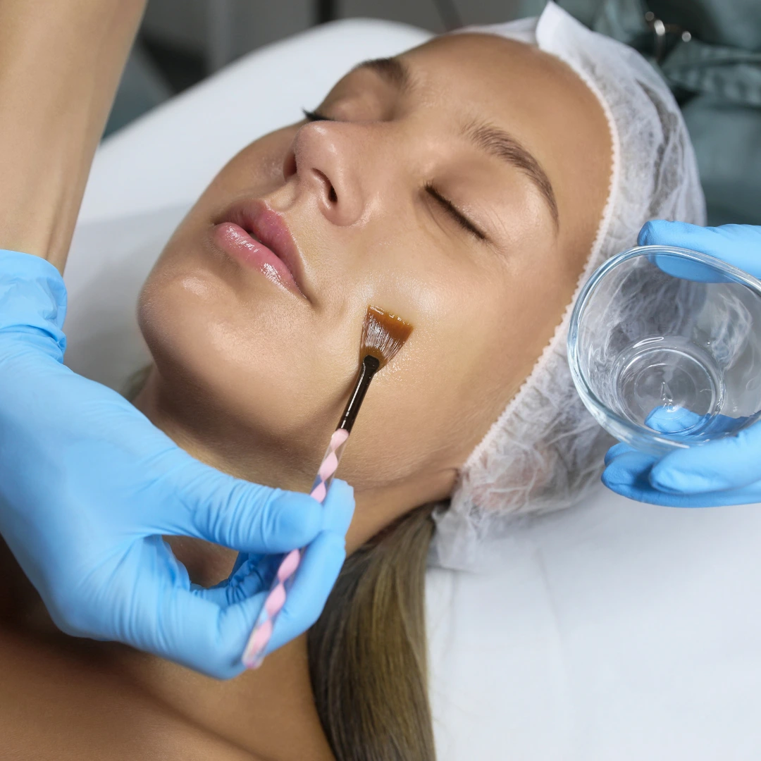 chemical peel key to beautiful skin