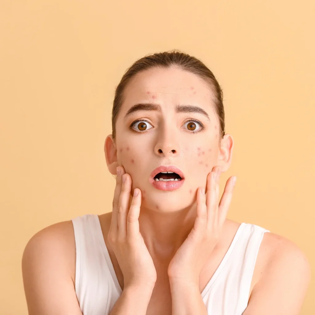 how to remove acne scars naturally in a week