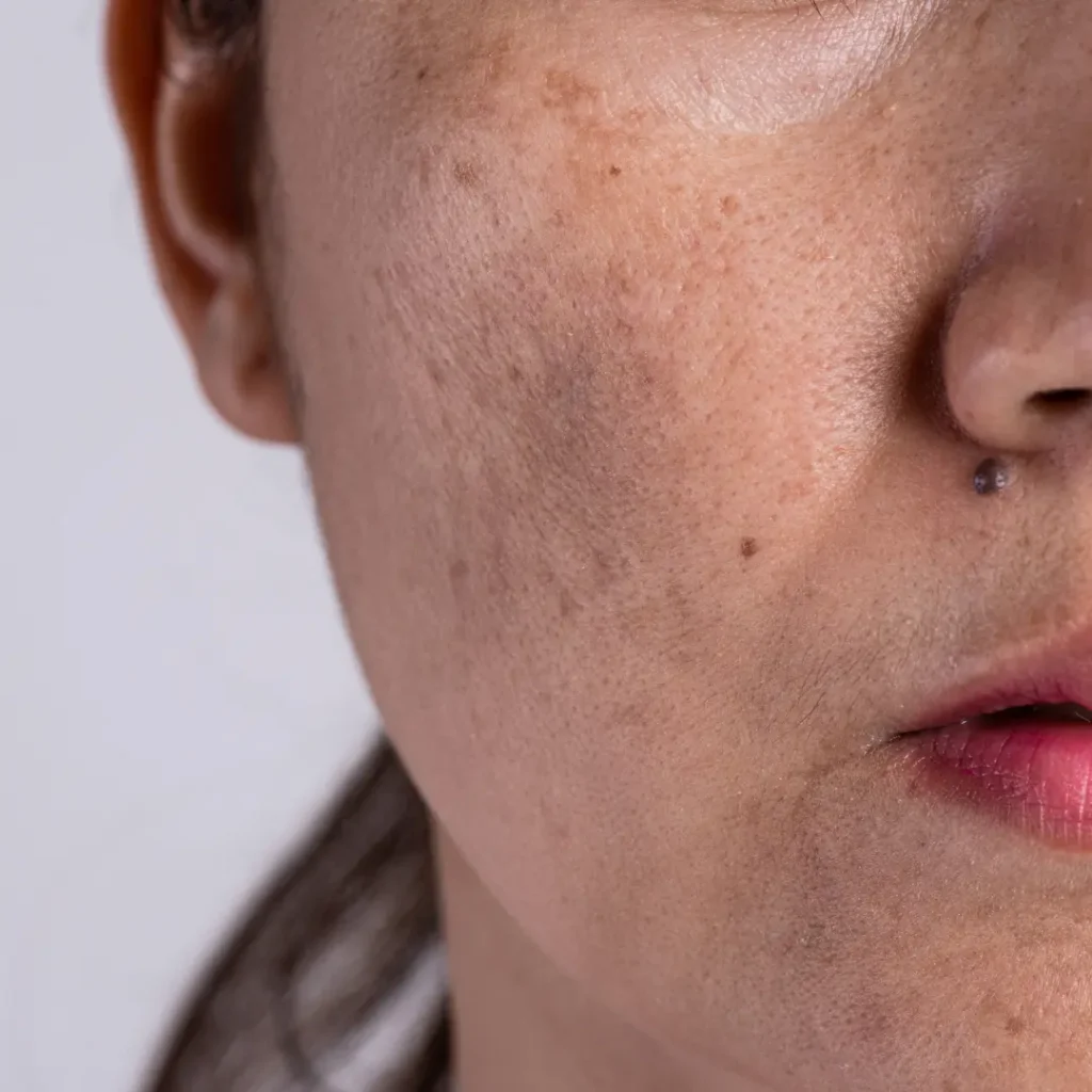 melasma symptoms how to identify it early