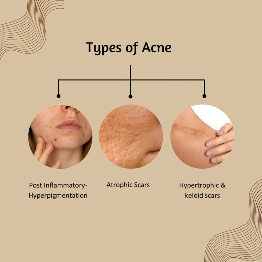 types of acne scars