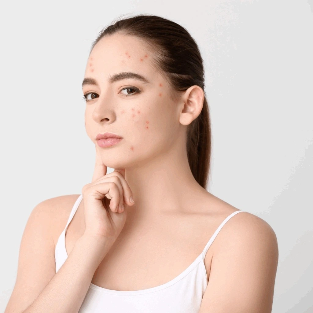 what-causes-pimples-on-forehead-top-10-reasons-for-pimples-on-forehead