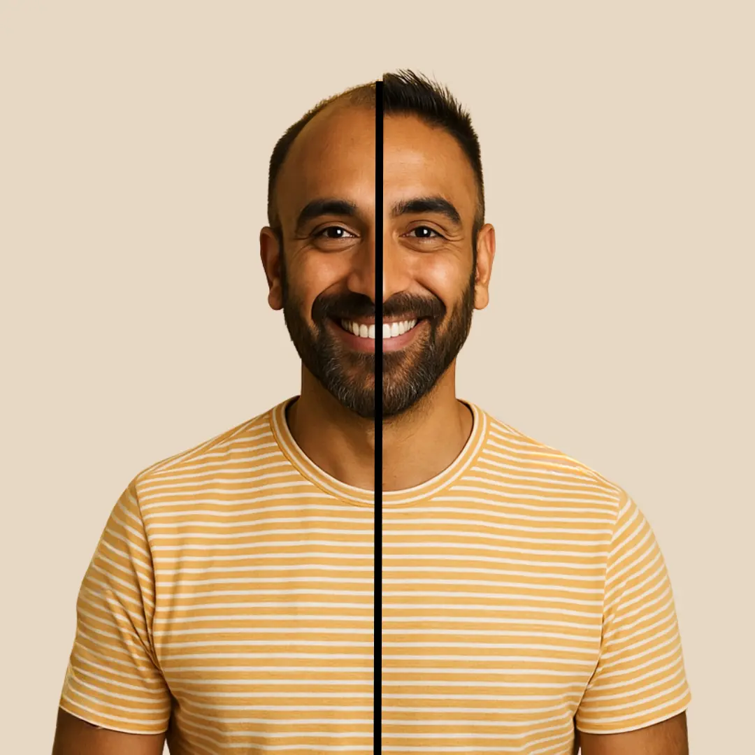 Hair transplant male before after