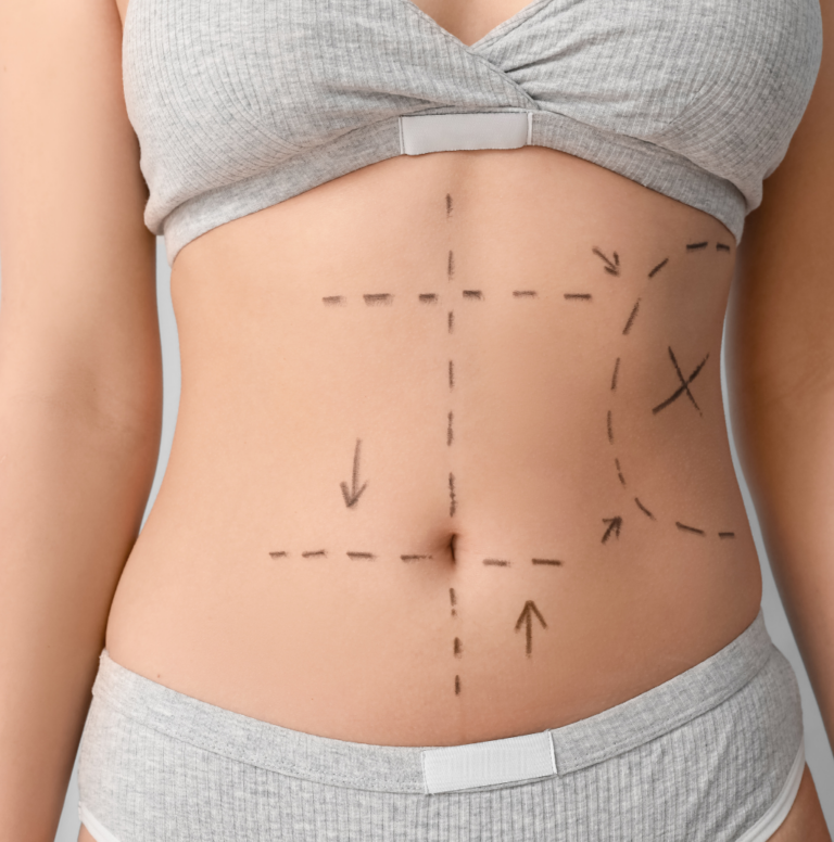 what is liposuction