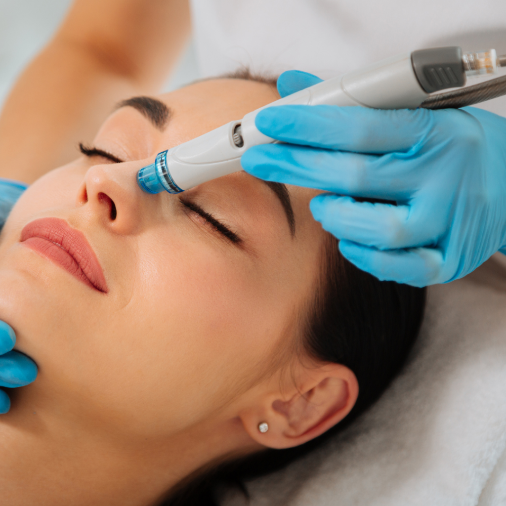HydraFacial for Acne-Prone Skin (1)