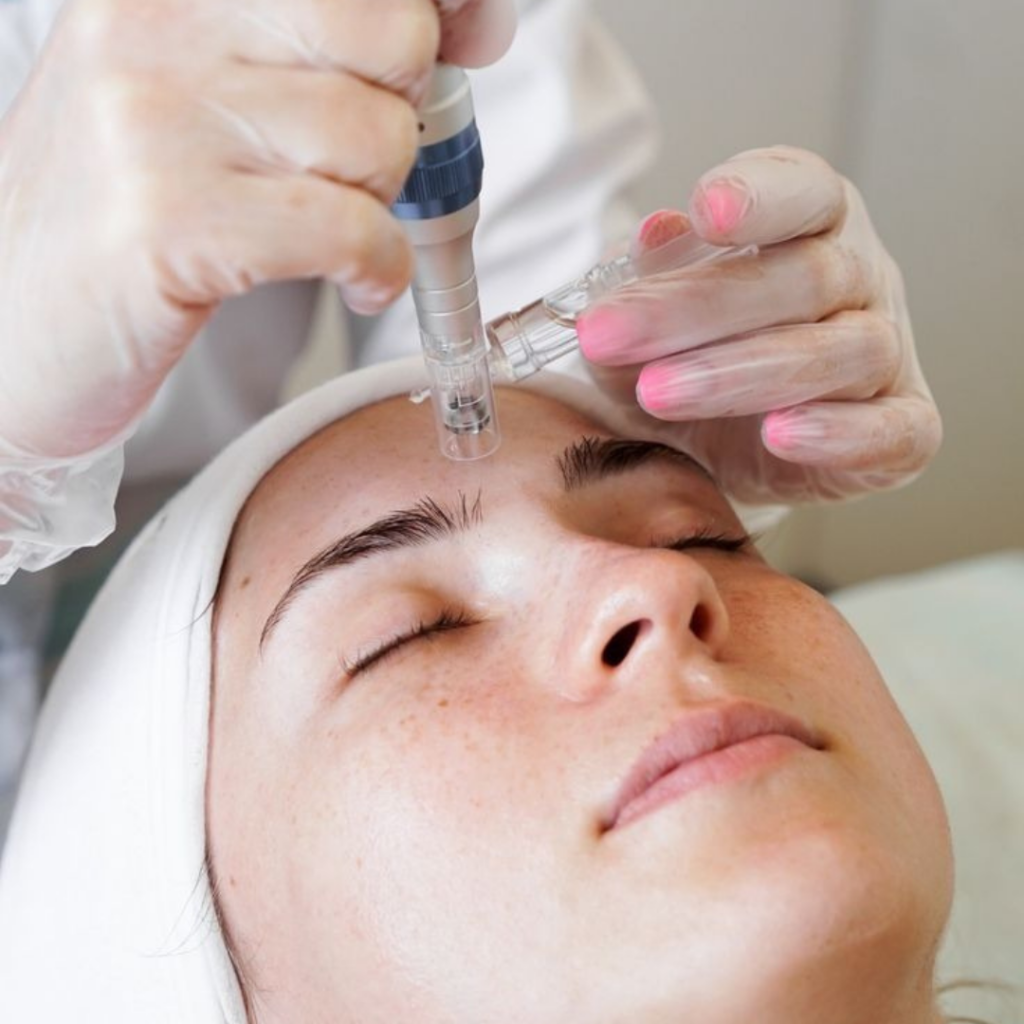 Micro needling with PRP (Platelet-Rich Plasma) for acne