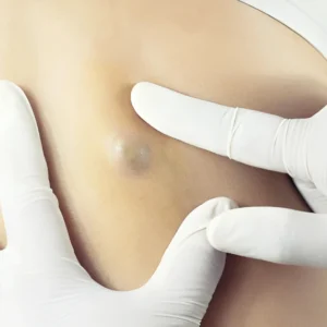 Sebaceous Cysts by Surgical Removal