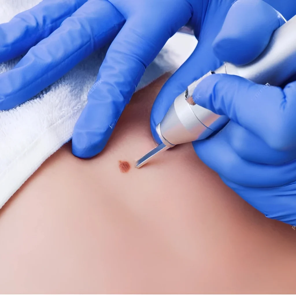 Treatment of Seborrheic Keratosis with Laser (2)