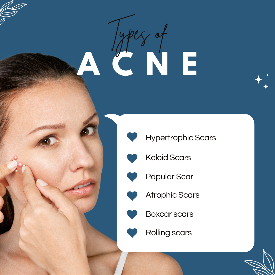 Types of acne