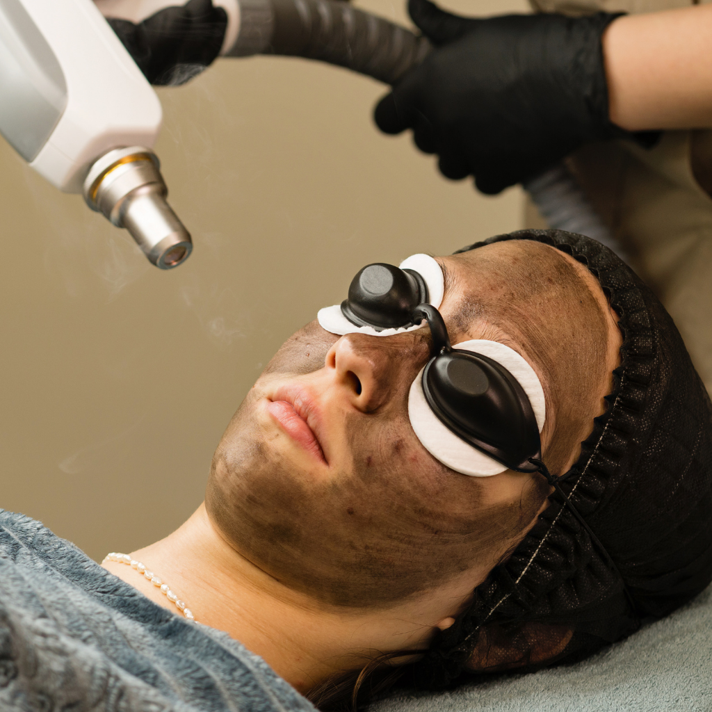 Carbon Facial Benefits in Pune