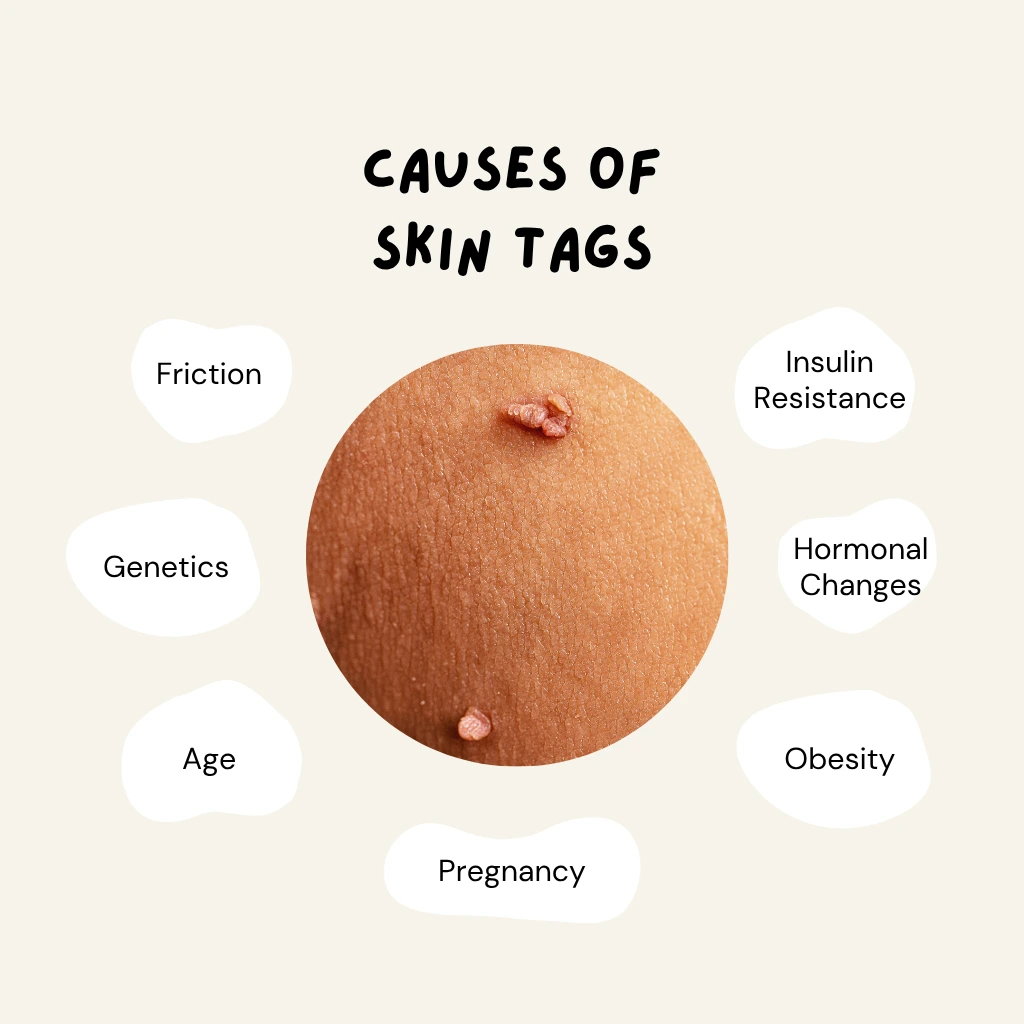 causes of skintags