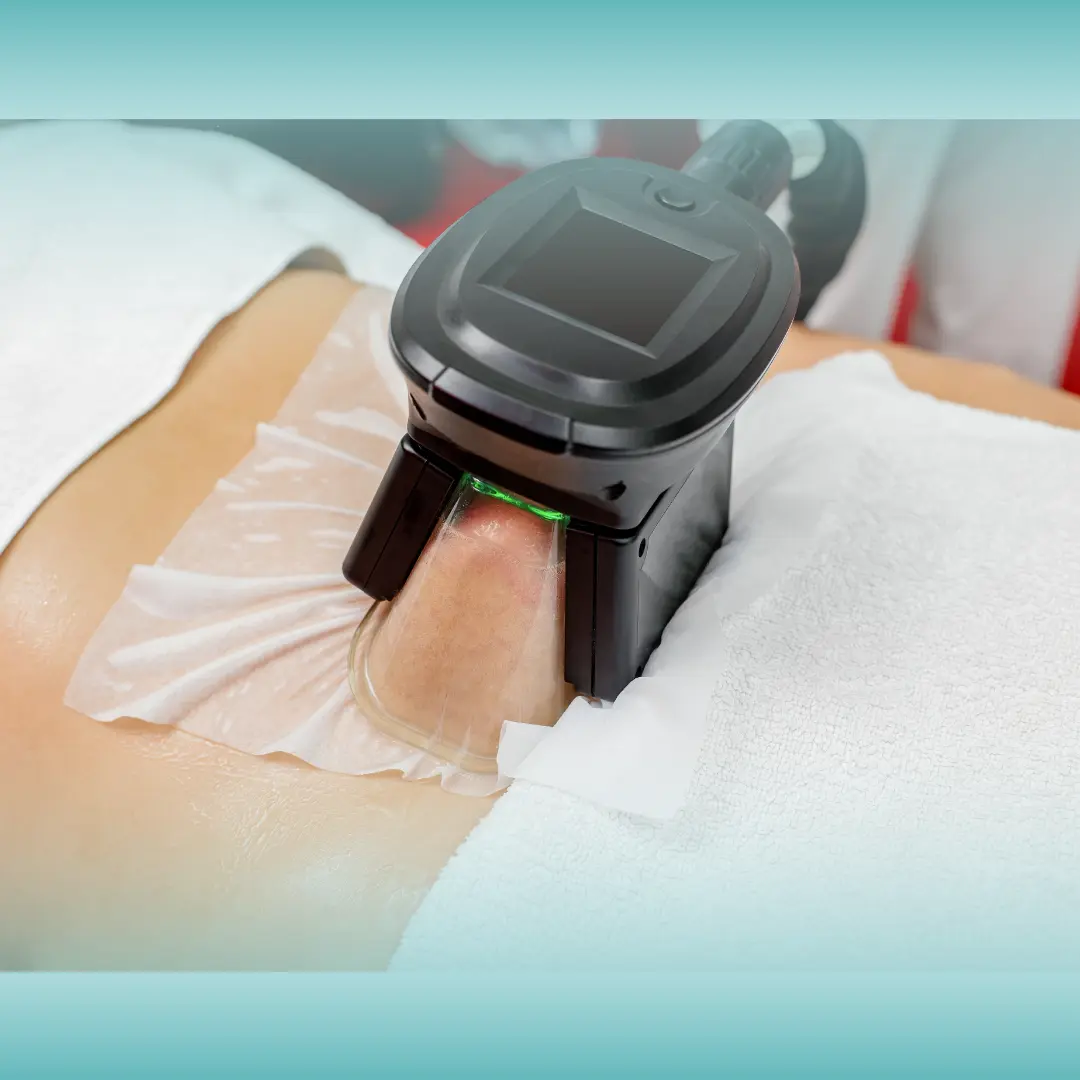 cryoliypolysis fat reduction