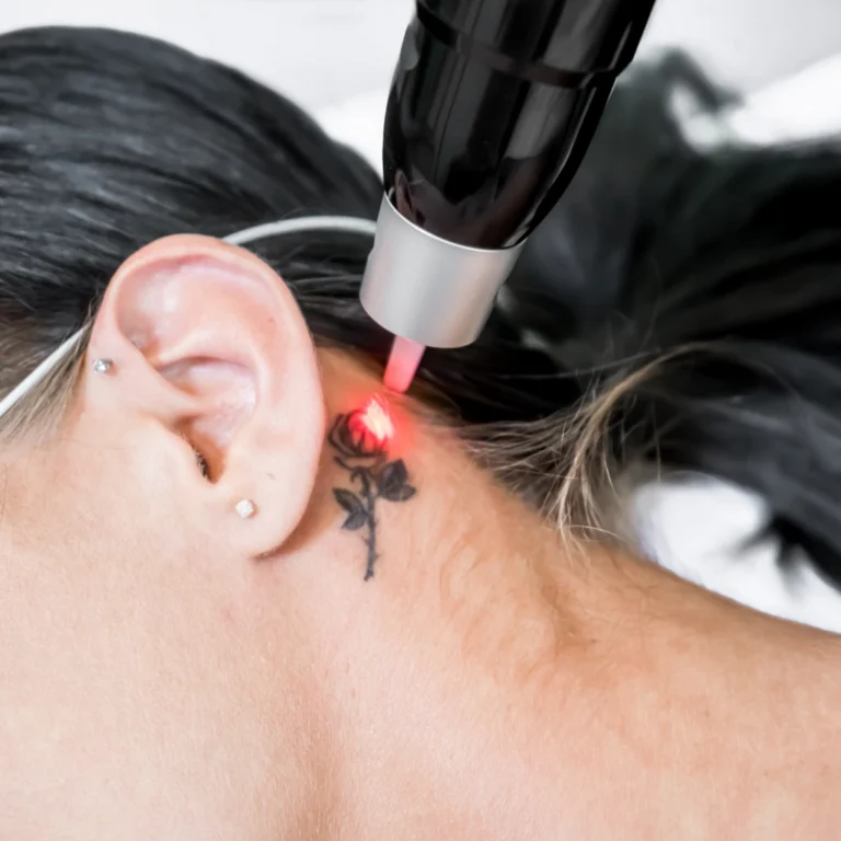 tattoo removal