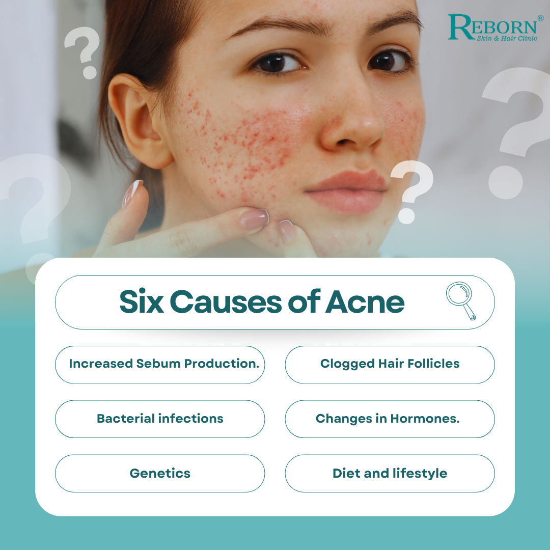 hyd- causes of acne
