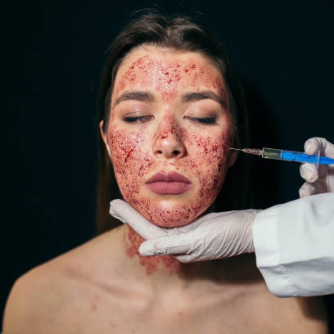 Vampire facial