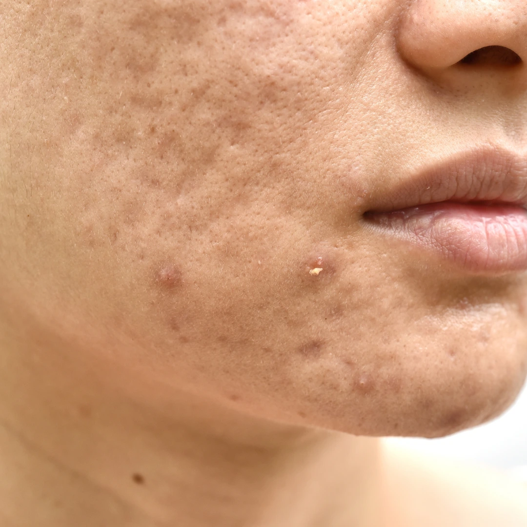 Acne Scar Pigmentation Treatment