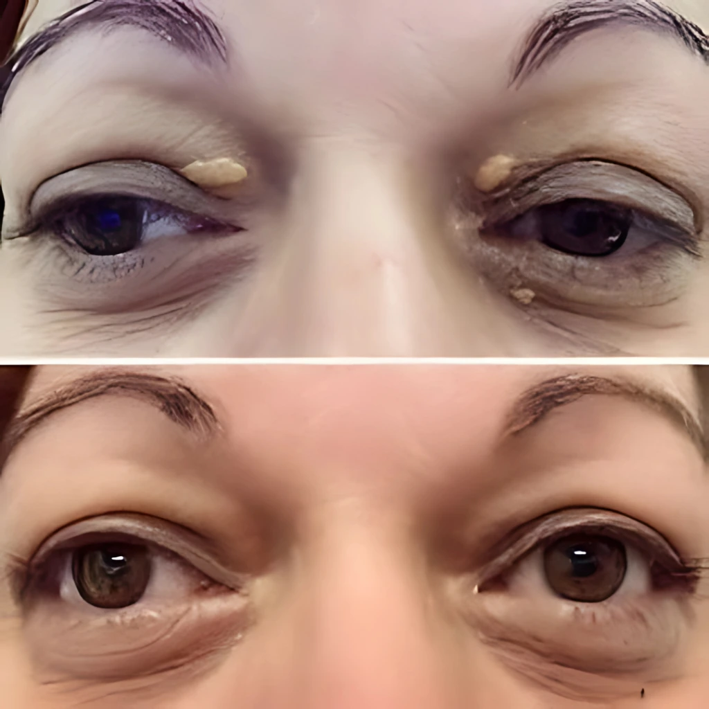 xanthelasma