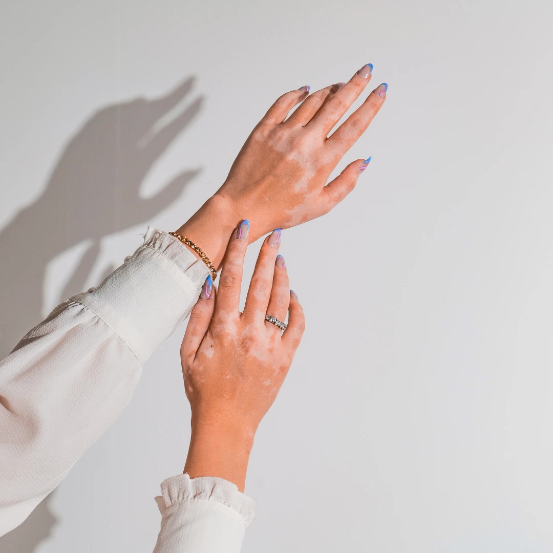 How I cured my vitiligo - Real patient story
