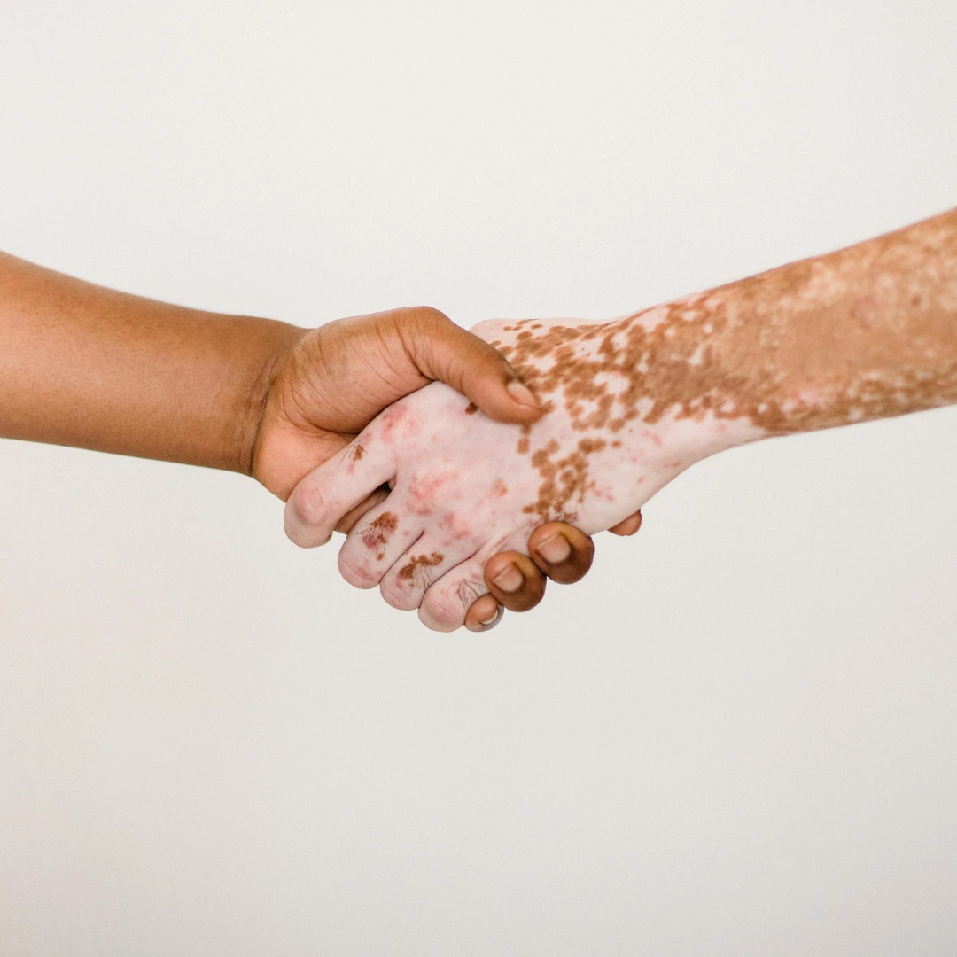 Segmental Vitiligo Causes, Symptoms, and Treatment