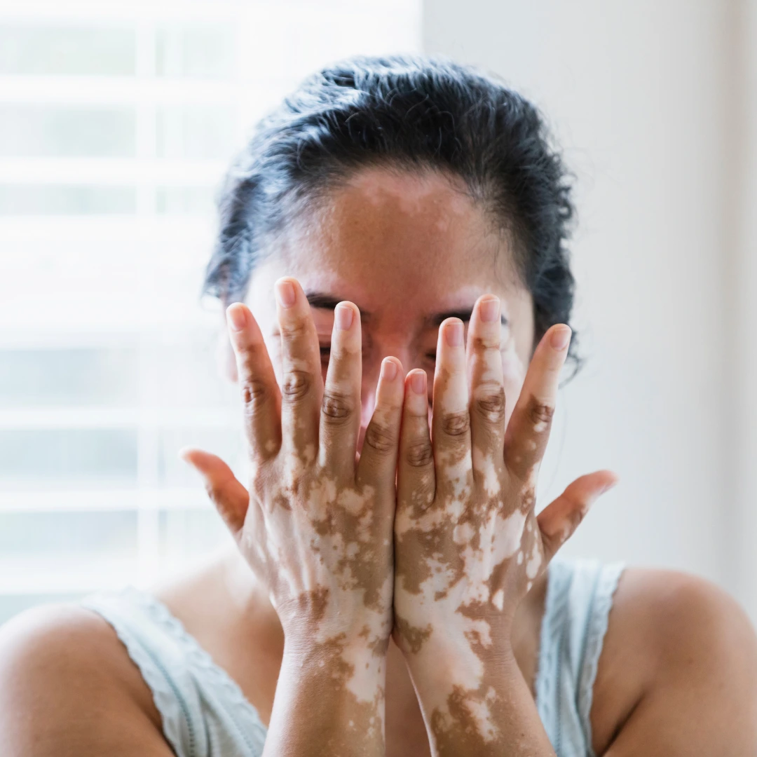 Vitiligo No More: A Real Story of Healing at Reborn Skin Clinic in Hyderabad