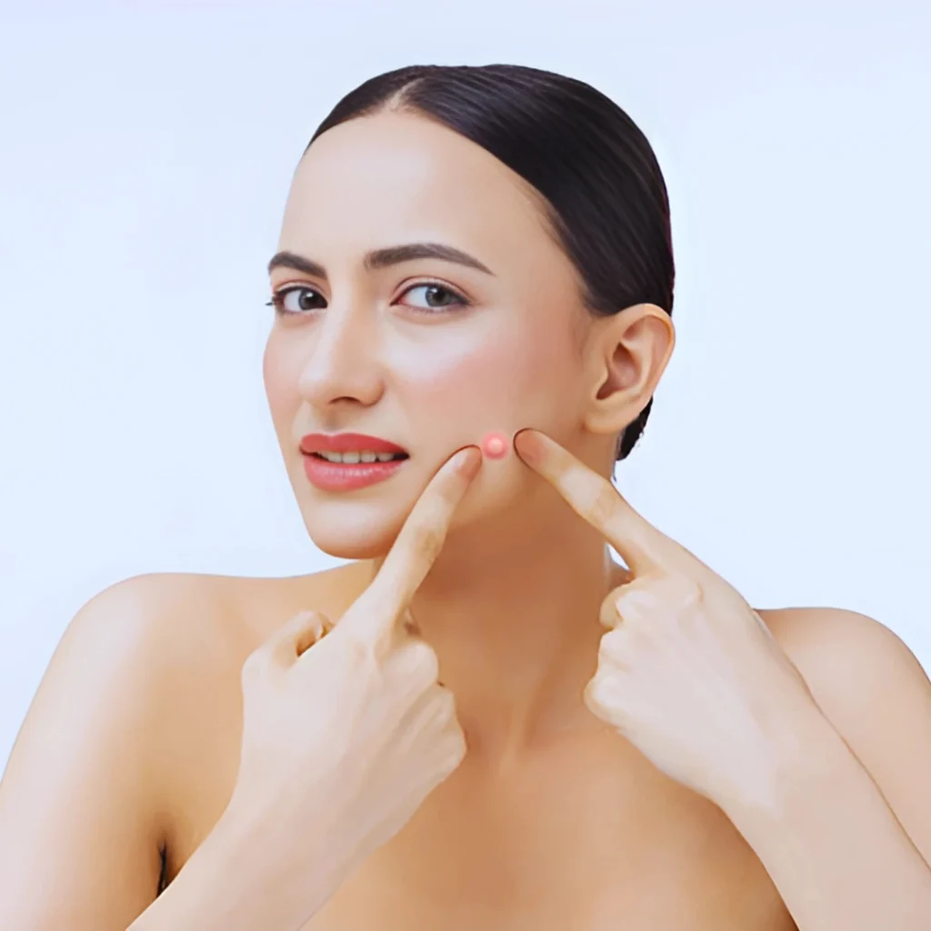 Still Breaking Out as an Adult? Here’s How to Fix the Acne—and the Spots It Leaves Behind