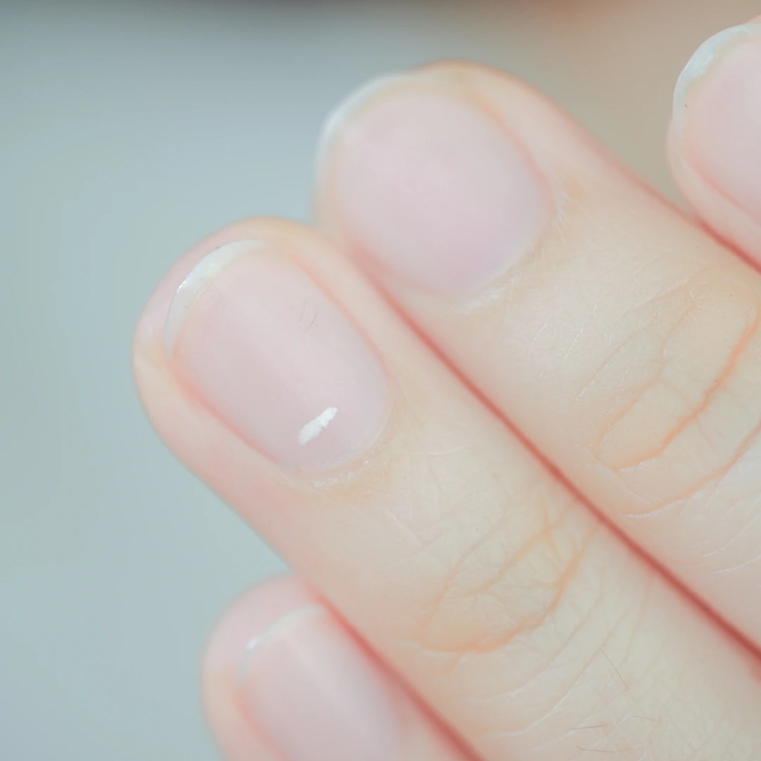 White Spots on Nails: Should You Be Worried?