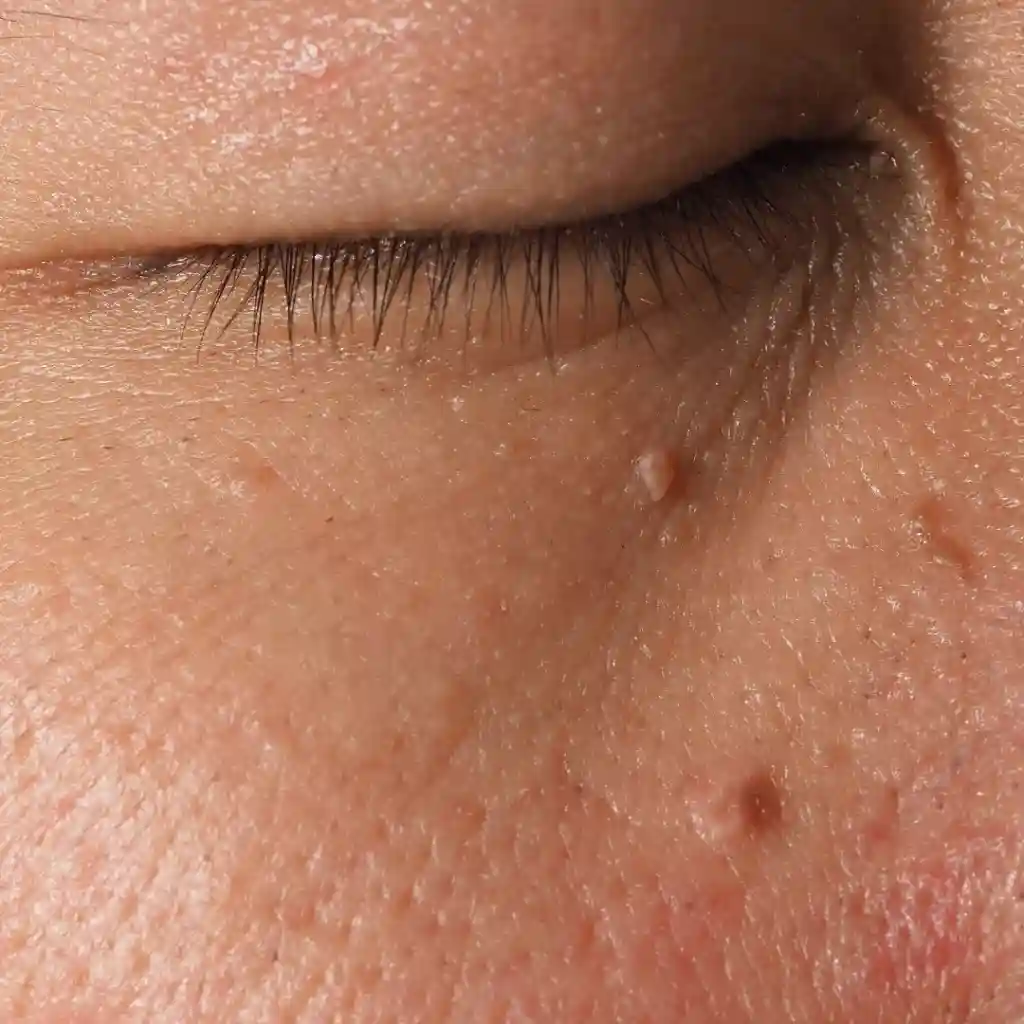 what is the cause of skin tags_IMGCentury