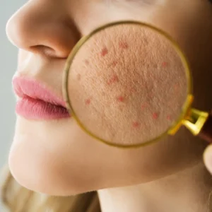 Acne vs Pimples What’s the Difference and How to Treat Them