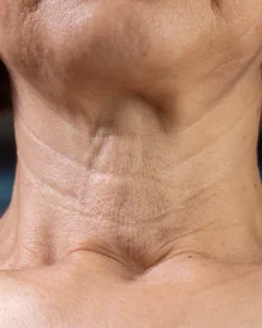 How to Get Rid of Neck Lines