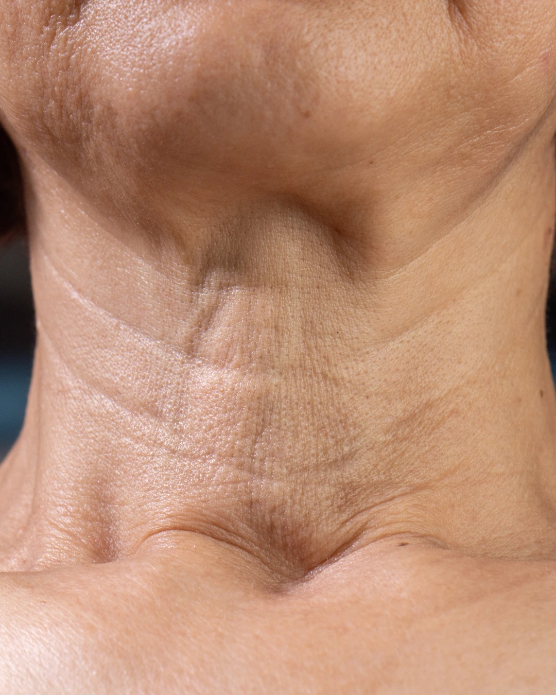 How to Get Rid of Neck Lines