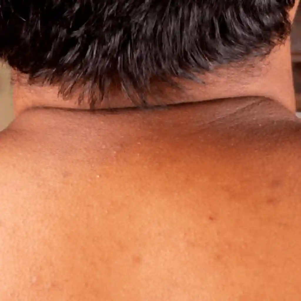 how to get rid of black neck