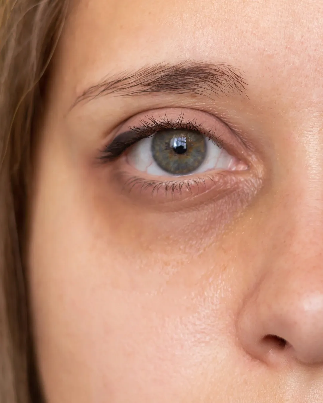 sunken-eyes-–-causes,-symptoms-&-effective-treatments