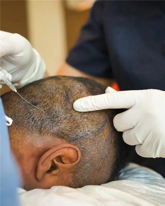 hair transplant price in india how it works, cost by city & what to expect