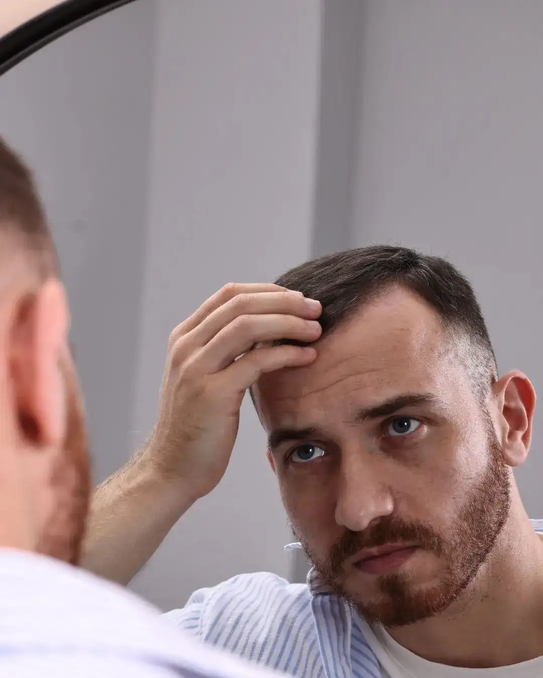 understanding a receding hairline_IMGCentury