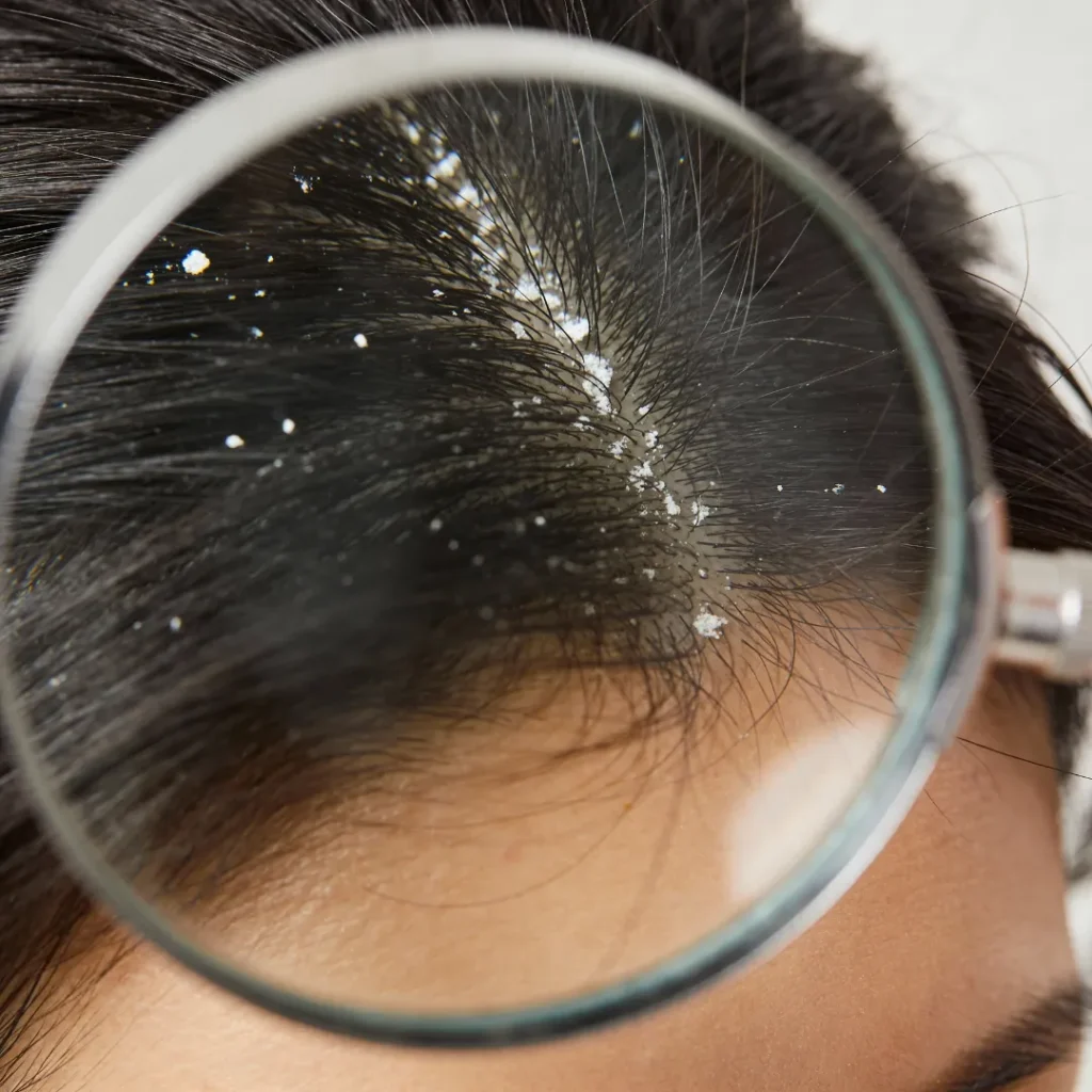 Can Dandruff Cause Hair Fall?