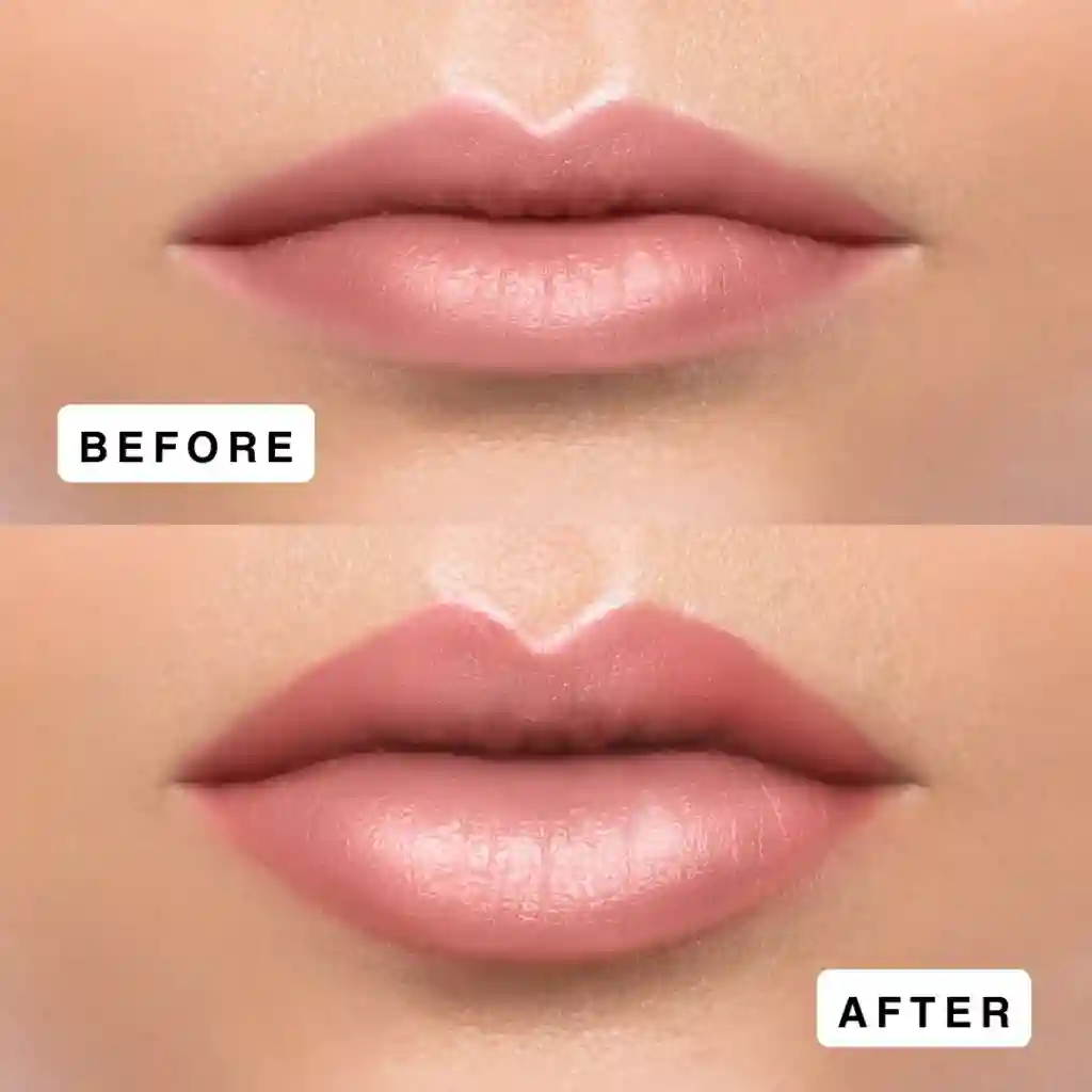lip fillers before and after realistic results_IMGCentury