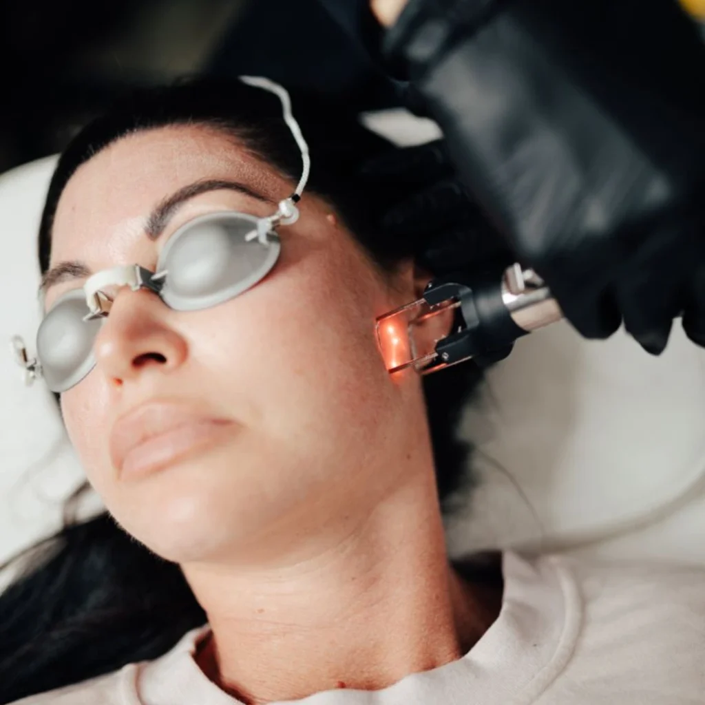 what is co2 laser treatment for acne scars