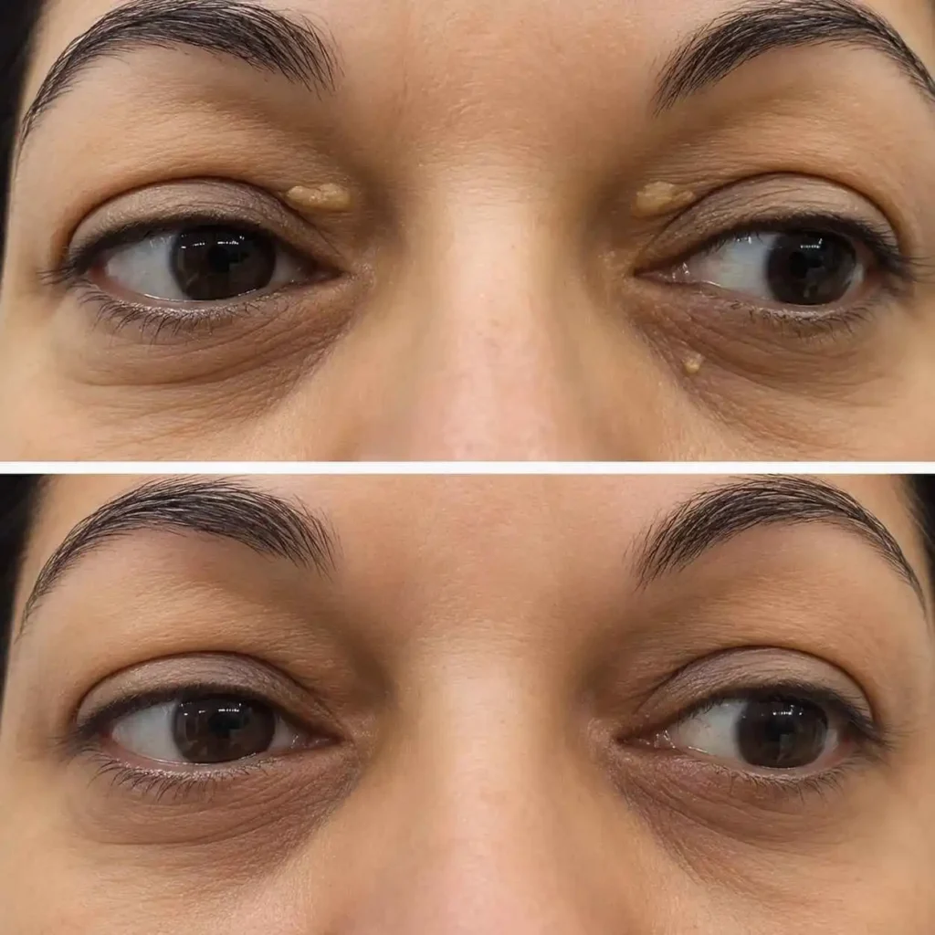 xanthelasma-before-after-img